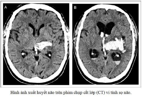 Hình Ảnh Đột Quỵ Xuất Huyết Não