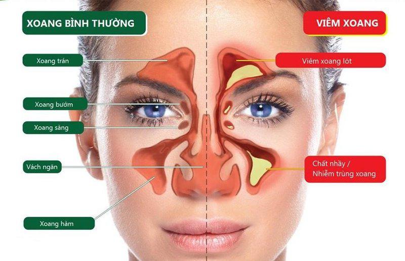 Vị Trí Các Xoang Bị Viêm.